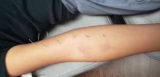 dry needling 